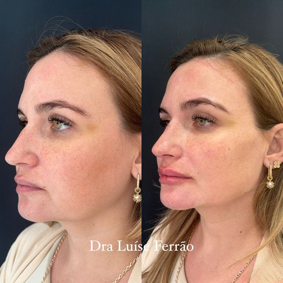 Antes e depois de perfil, com contorno e proporções da face trabalhados.