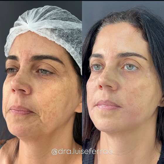 Antes e depois em três quartos, com reposicionamento e firmeza do contorno facial.
