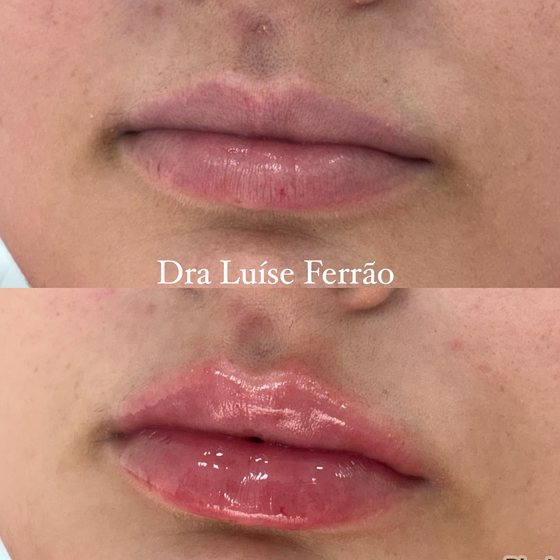 Antes e depois em detalhe da região dos lábios.