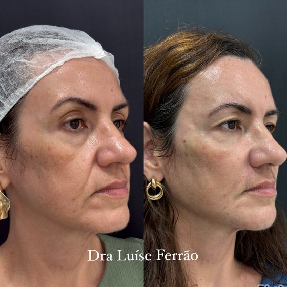 Antes e depois em três quartos, com reposicionamento do terço médio e inferior da face.