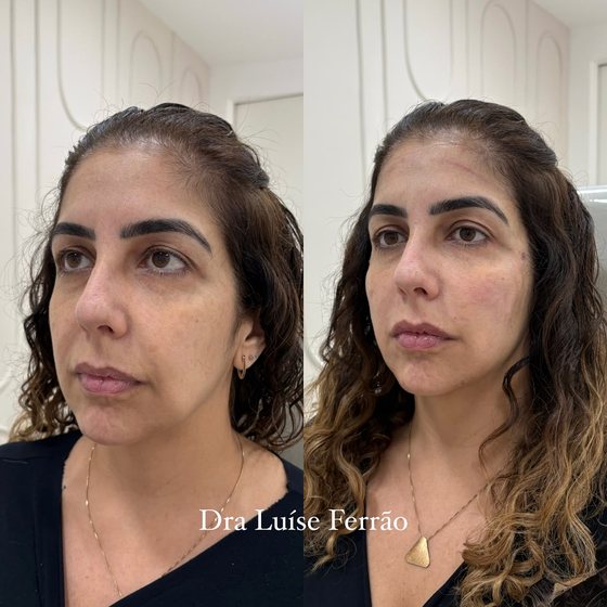 Antes e depois frontal, com definição do contorno facial.