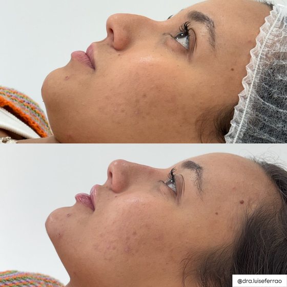 Antes e depois do perfil, com equilíbrio entre nariz, lábios e queixo.