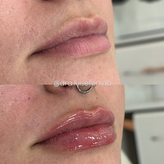 Antes e depois dos lábios em vista de três quartos.