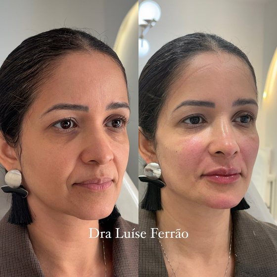 Antes e depois em três quartos, com equilíbrio entre os terços da face.